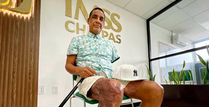 Médicos del IMSS en Chiapas aplican técnicas avanzadas de injertos cutáneos y cicatrización a paciente electrocutado