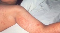 York Region Public Health confirms new measles case in Thornhill