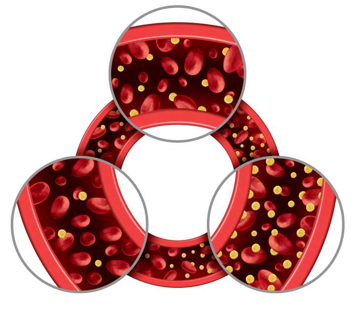 Cadisegliatin, an Oral Drug For Type 1 Diabetes, Begins Phase 3 Trial
