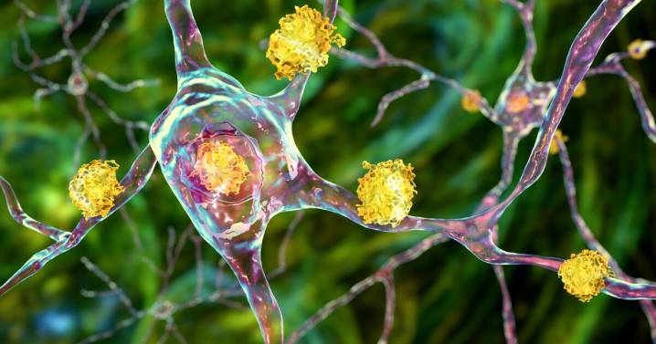 UK doctors achieve medical first with successful Huntington's disease treatment