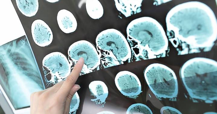 Thousands in UK have disease that can cause dementia if untreated