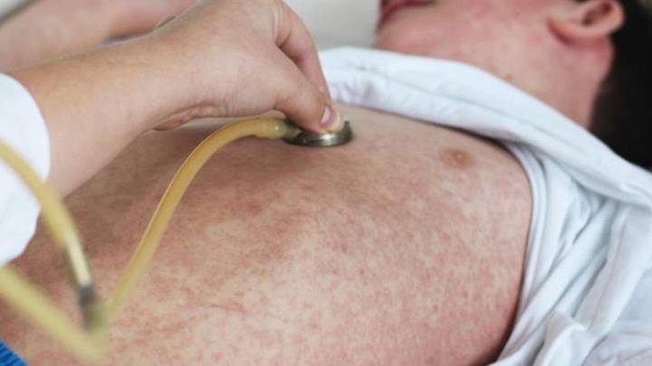 Two measles cases confirmed in Perth after returning from Bali