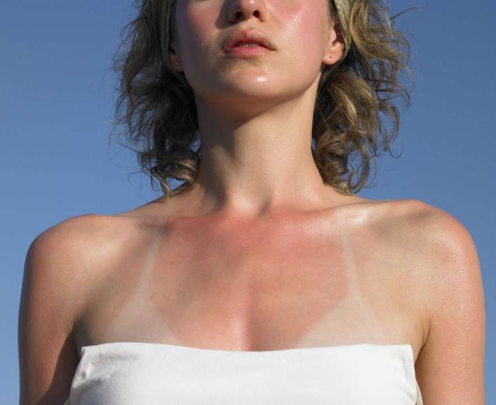 How Long Does Sunburn Last?