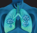 Summit Lung Cancer Drug Falls Short on Key Survival Goal in Global Study, Putting FDA Approval in Doubt