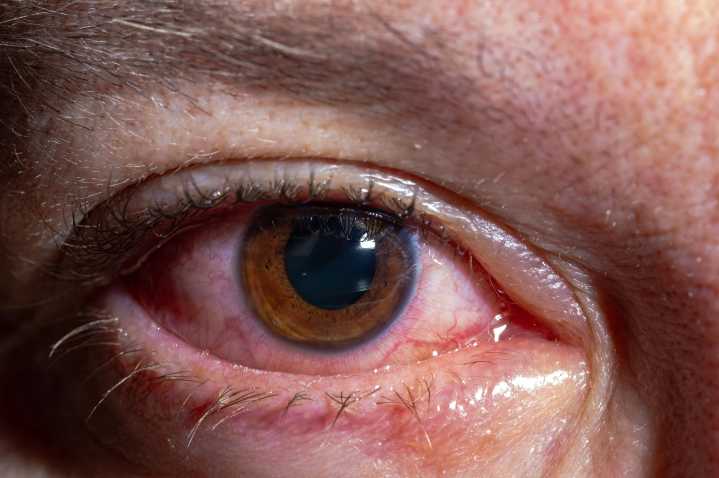 Changes in the Eye’s Blood Vessels Could Signal Early Risk for Alzheimer’s and Related Dementias