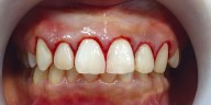 ¿Cómo eliminar la gingivitis rápido de manera natural? 