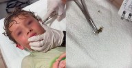 ¡Vacaciones de terror! Extraen cangrejo del oído de un niño [VIDEO]