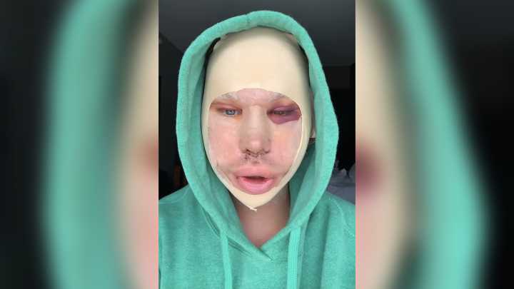 MTV reality star looks unrecognizable with swollen face covered in bandages after getting FIVE plastic surgeries at once