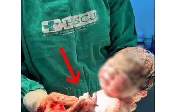 Nace bebé sano y salvo... ¡con el DIU en la mano!
