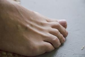 Scientists suggest ancient gene could offer cure for gout
