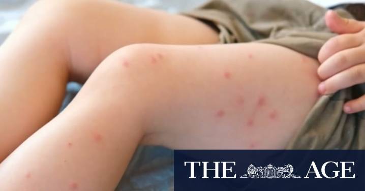 Measles cases spiking across Queensland