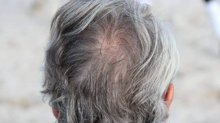 Aún hay esperanza: aquí puedes realizarte diagnósticos para la alopecia en Morelia