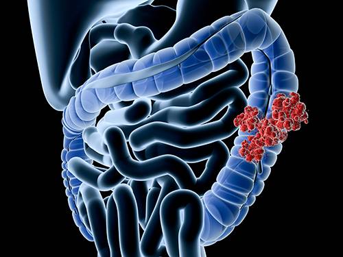 CRC Screening Uptake Unaffected by Personalized Risk Messages