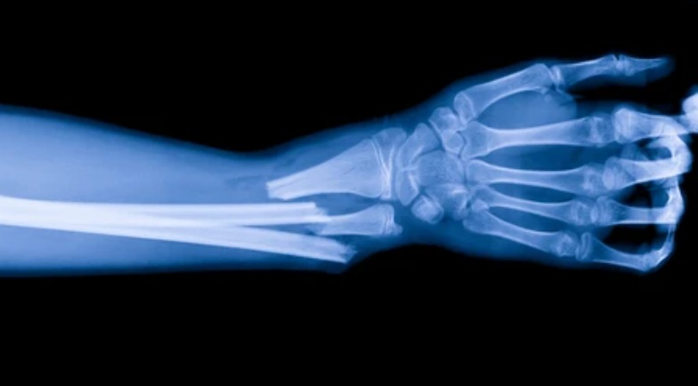 “Bone-02”, un pegamento óseo inspirado en ostras que repara fracturas en solo 3 minutos