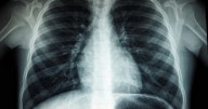 Duke study reveals new origin of deadly lung cancer, paving way for innovative treatments :: WRAL.com