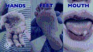 A closer look at the Hand, Foot, and Mouth Disease outbreak in Hidalgo County