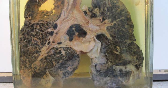 Qué es y cómo prevenir la silicosis, una enfermedad respiratoria de la que Ourense está a la cabeza de nuevos casos