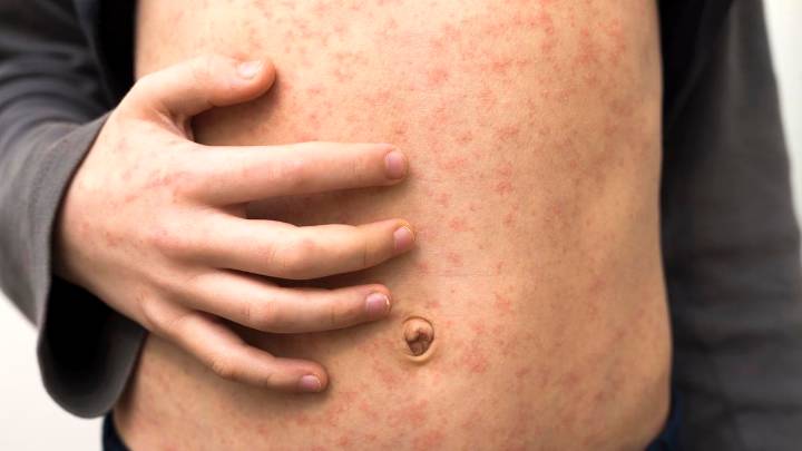 Measles in WA: Sixth case recorded in September, authorities urge families to check jab status before holidays