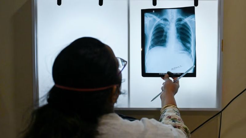 El Gobierno de este país prometió eliminar la tuberculosis para finales de 2025. No está yendo bien
