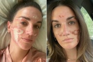 Woman Accuses Celebrity Facialist of Permanently Scarring Her Face