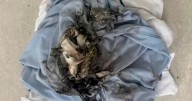 Urgent warning after woman 'set her head on fire' by vaping in hospital bed