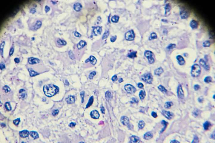 Immune Profiling Reveals Therapeutic Targets in Pediatric Germ Cell Tumors