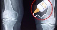 Según un informe, científicos chinos crean un pegamento óseo para reparar fracturas en minutos