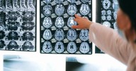 AI test gives quicker and more accurate concussion checks