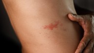 Chickenpox: why the UK has approved the MMRV vaccine in under-fours but the US is preparing to restrict it
