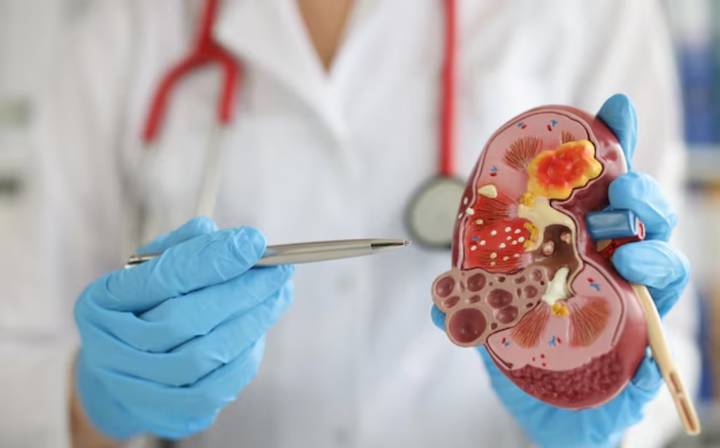 PKD, la enfermedad renal que pocos conocen
