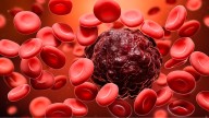 Un 30% de los pacientes con un tipo de leucemia vive sin tratamiento