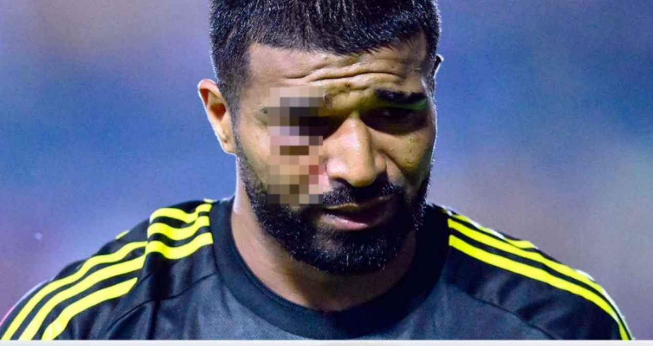 Rodrigo ‘Búfalo’ Aguirre sufre fuerte golpe en el ojo tras un choque con el portero del Atlético de San Luis