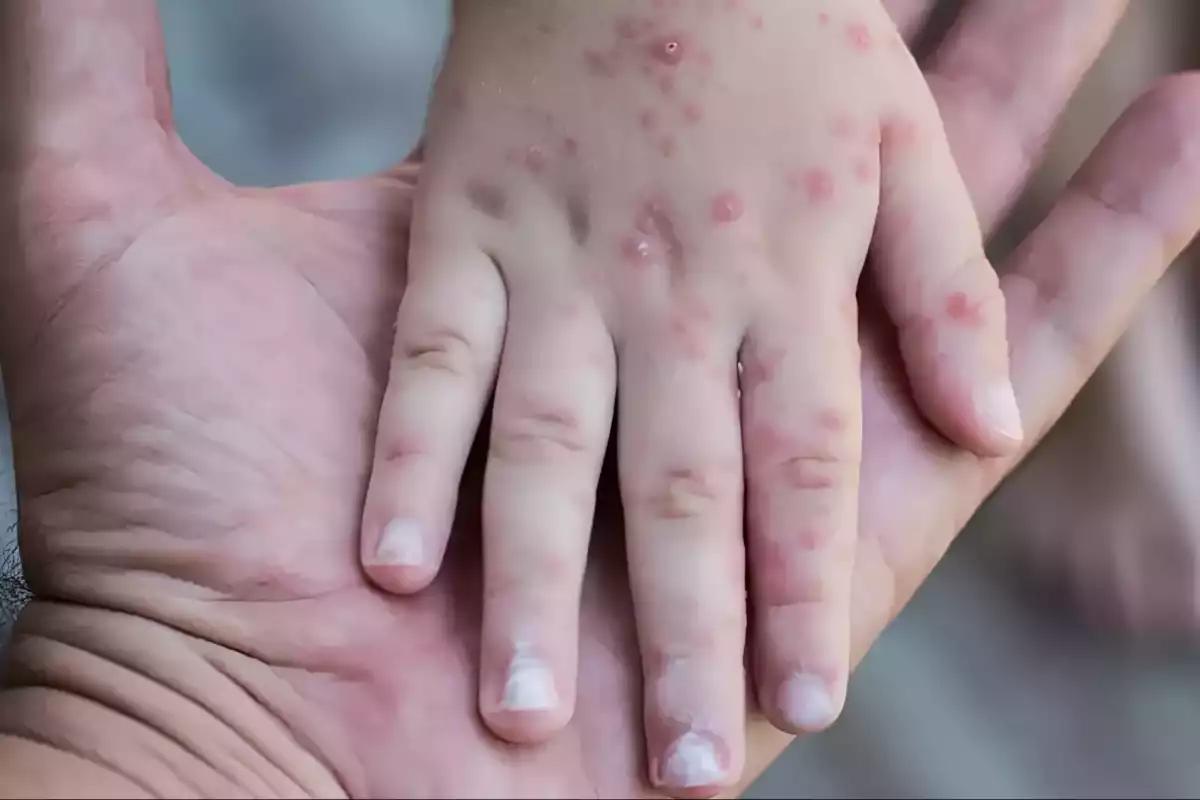 Coxsackie aumenta en Campeche: Van 49 casos este 2025 con 6 nuevos contagios; ¿dónde se concentran?
