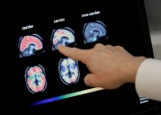 Revisión sobre el Alzheimer. La ciencia consiguió ralentizar la enfermedad y la lucha entró en una nueva era
