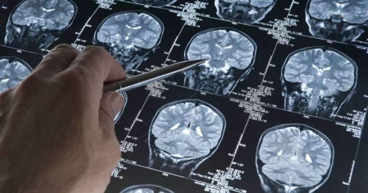 Investigación liderada por colombiano revela cómo progresa el Alzheimer: luces para nuevos tratamientos