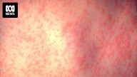 Measles alert issued for Gold Coast as Queensland cases climb