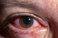 Changes in the Eye’s Blood Vessels Could Signal Early Risk for Alzheimer’s and Related Dementias