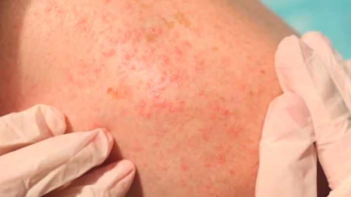 Se Recupera Niño Contagiado de Sarampión en Jalisco; Descartan Riesgos