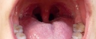 Your Own Mouth Bacteria Could Give You a Heart Attack, New Study Suggests