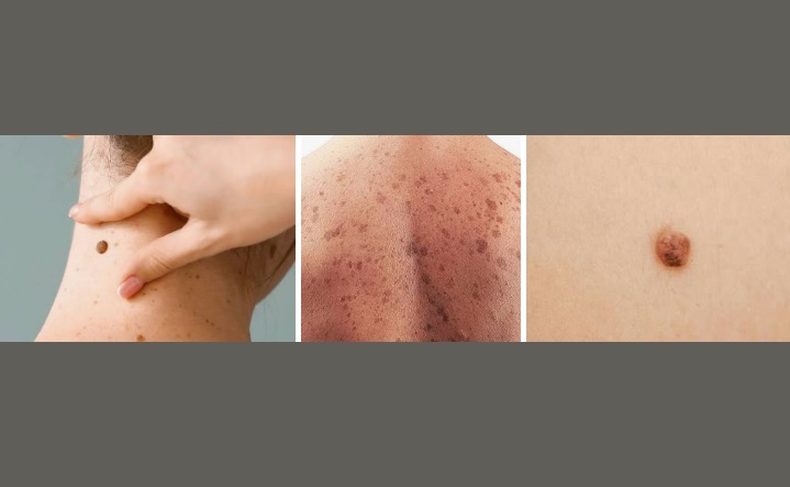 El cáncer de piel deja imborrables cicatrices: recomiendan usar protector solar