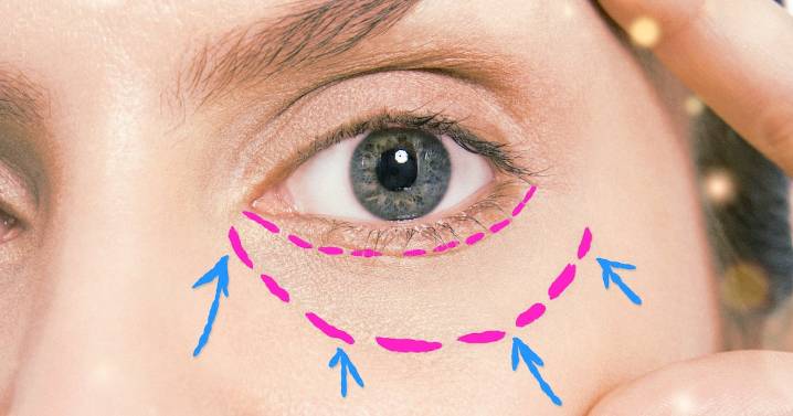Why Lower Eyelid Plastic Surgery Is Trending Right Now