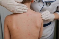 ALERTA! Corrientes atenta ante brotes de sarampión en Paraguay y casos en Misiones