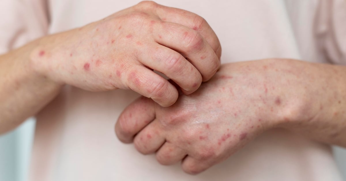 Confirman segundo caso de sarampión en Tabasco: Adolescente contrajo el virus en Europa