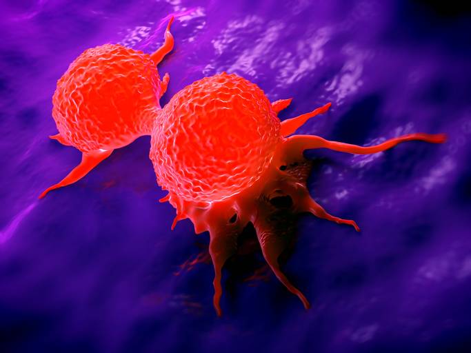 Dual Screening: MBI Plus Tomosynthesis Finds More Invasive Breast Cancers