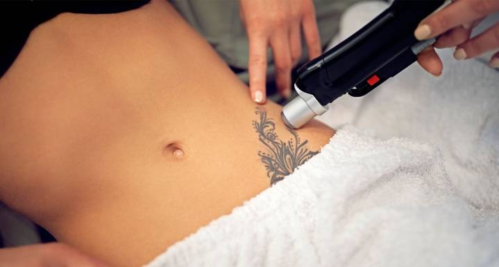 One Woman's Journey to Removing Her Tattoos