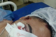 Un joven perdió un ojo tras recibir un disparo de bala de goma en un operativo policial