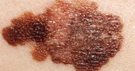 An at-home skin cancer test is being tested by University of Michigan researchers
