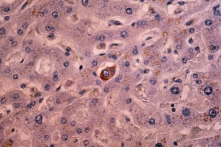 Early Breast Cancer Survivors Face Only Slight Second Cancer Risk