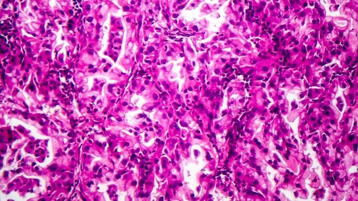 Summit Therapeutics hits possible snag on lung cancer drug seen as blockbuster