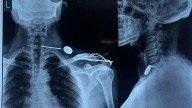 Indore News: Steel Nail Moves From Man’s Shoulder To Throat, Removed In 2.5